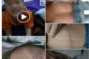 Thêm bé trai 9 tuổi ở HN nghi bị cha bạo hành dã man