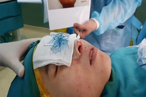 Mũi hoại tử xanh lè do dùng chỉ khâu da để nâng mũi