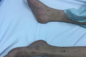 Một thiếu nữ ở Hà Nội bị 'vi khuẩn ăn não'