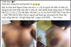 Nâng ngực xong nhập viện: Bộ Y tế khẳng định BV không sai