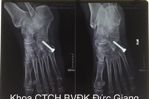 Mang 'bệnh lạ' suốt 20 năm sau cú ngã trẹo chân