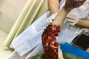 Bất cẩn, người đàn ông bị máy bóc gỗ 'cướp' 50% da cánh tay 