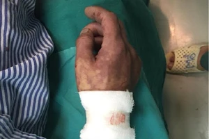 Nam thanh niên bị tấm kính rơi thẳng vào cánh tay