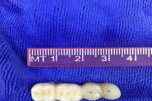Hóc 4 chiếc răng giả, cụ ông 90 tuổi suýt tắt thở