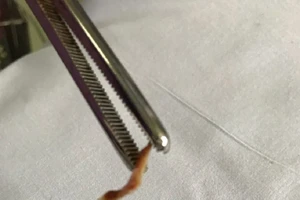 'Quên' xương vịt trong phế quản, 3 tháng sau mới biết