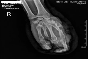 Bất cẩn, người đàn ông bị máy ép gạch nghiền nát bàn tay