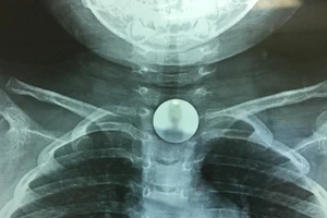 30 giây lấy đồng xu mắc kẹt trong họng bé gái 3 tuổi
