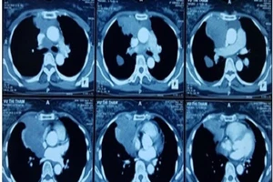 Xuyên Tết cứu bệnh nhân 2 lần cận kề cửa tử