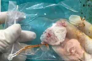 Mổ lấy ổ sán khổng lồ trong não người thích ăn tiết canh 