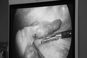 Viêm ruột thừa do nuốt xương cá nhiều năm không hay biết