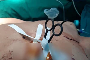 Bất cẩn, người đàn ông bị kéo đâm thủng màng tim