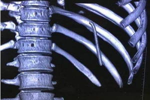 Bác sĩ 'dụ' chiếc đinh trong ngực bệnh nhân ra ngoài