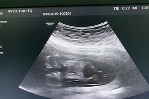 Hiếm gặp: Cặp song thai dính nhau chỉ có 1 trái tim