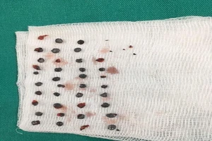 Phẫu thuật lấy 39 viên đạn trên mặt do bị bắn bằng súng tự chế