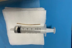 Tạo đường hầm trong bụng cứu bệnh nhân thích ngậm tăm đi ngủ