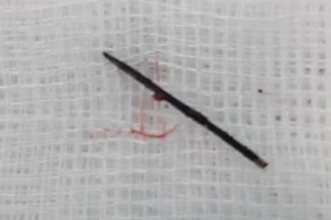 Sững sờ khi bác sĩ nói trong bụng con có cây kim dài 17 mm