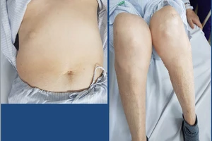 Báo động tình trạng lạm dụng corticoid do mua thuốc “dễ dãi“