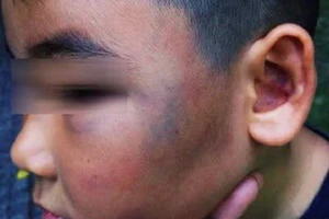 Xử kín vụ tài xế xe ôm đánh bé 8 tuổi bầm tím mặt