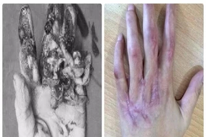 Hồi sinh kỳ diệu bàn tay dập nát cho cô gái trẻ