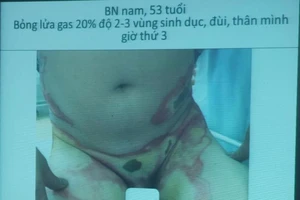 Bật lửa phát nổ trong túi quần, người đàn ông bỏng nặng