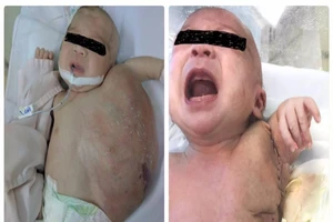 Bé sơ sinh mang khối bướu 'khủng' gần 1 kg