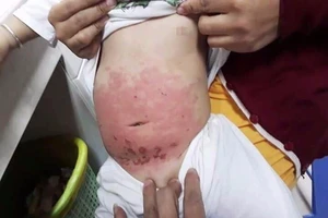 Mẹ dùng dầu gió bất cẩn, bé 14 tháng tuổi bị bỏng 