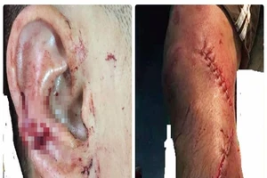 Vợ chém sứt tai và đứt gân chân chồng nhậu say