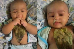 Bé gái bỏng ngực nặng vì... trị sổ mũi bằng lá trầu