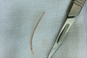 Tá hỏa không biết tăm, xương cá chui vào bụng lúc nào