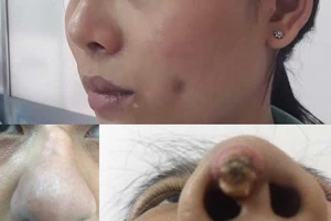 Lủng má, lồi mũi vì ham làm đẹp giá rẻ dịp Tết