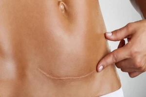 Bất ngờ vì thai làm tổ ở vết sẹo mổ cũ 