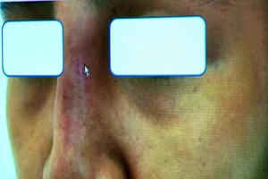 Mắt mũi bầm đen vì... nâng mũi