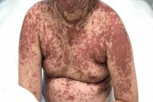 Bé gái nổi ban đỏ toàn thân sau khi uống thuốc hạ sốt