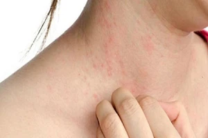 Nữ bệnh nhân tử vong sau khi chích thuốc chữa dị ứng 