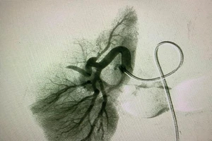 Hết lo cắt thận nhờ mũi tiêm thuốc nhỏ 