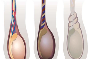 Bị cắt bỏ tinh hoàn do sưng đau bìu