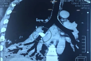 Cắt nửa lá phổi vì hóc xương cá 5 năm trước