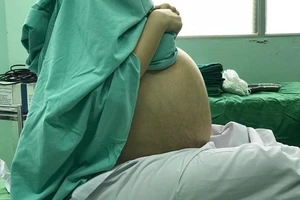 Cô gái mang khối u khổng lồ 18kg nhàm là béo bụng