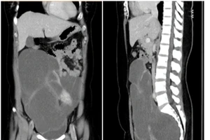 Đi tiểu nhiều, đi khám mới hay khối u 2,8 kg ở vùng chậu