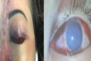 Tiêm thuốc nâng mũi ở chung cư, cô gái bị mù một mắt