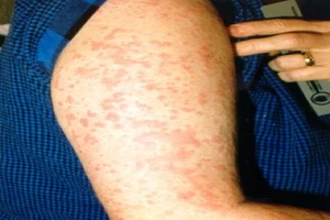 Bệnh hiếm khiến chàng kỹ sư sụt 10 kg một tháng 