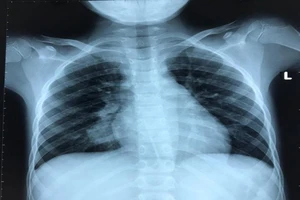 Bé trai ho ra máu, chuyển 3 BV mới phát hiện bệnh