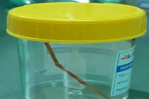 Hoãn mổ tim vì tăm tre 6 cm đâm thủng ruột 