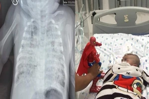 Bé 2 tháng tuổi phổi trắng xóa vì nhiễm lao từ cha 