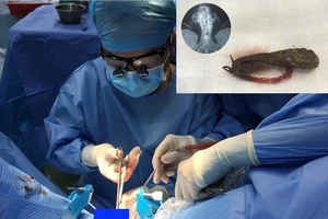 Cuộn dây cước câu cá bị bỏ quên 11 năm trong 'của quý'