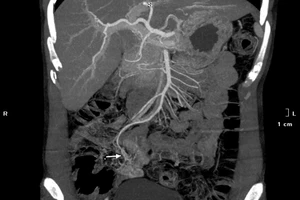  Mất 3,5 lít máu vì bỏ qua dấu hiệu đi cầu phân đen