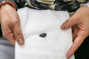 Hóc hạt sapôchê 4 năm không biết, toàn đi khám bệnh ho