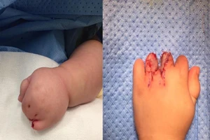 Bé gái bị dính ngón hiếm gặp từ trong bào thai