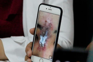 Nữ sinh viên suýt bay mất mũi vì tiêm filler 