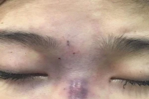 Chồng tiêm filler làm mù mắt vợ